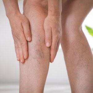 Varicose veins symptoms London