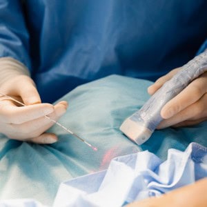 endovenous laser ablation