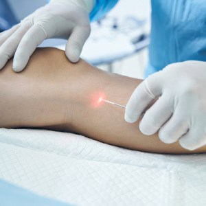endovenous laser procedure