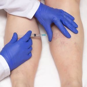 foam sclerotherapy london
