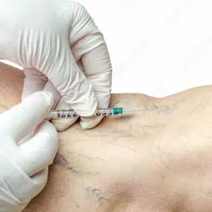 sclerotherapy near me