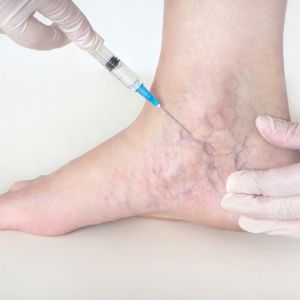 sclerotherapy london