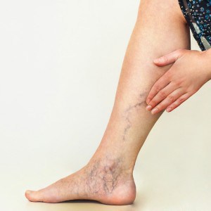 varicose vein removal London