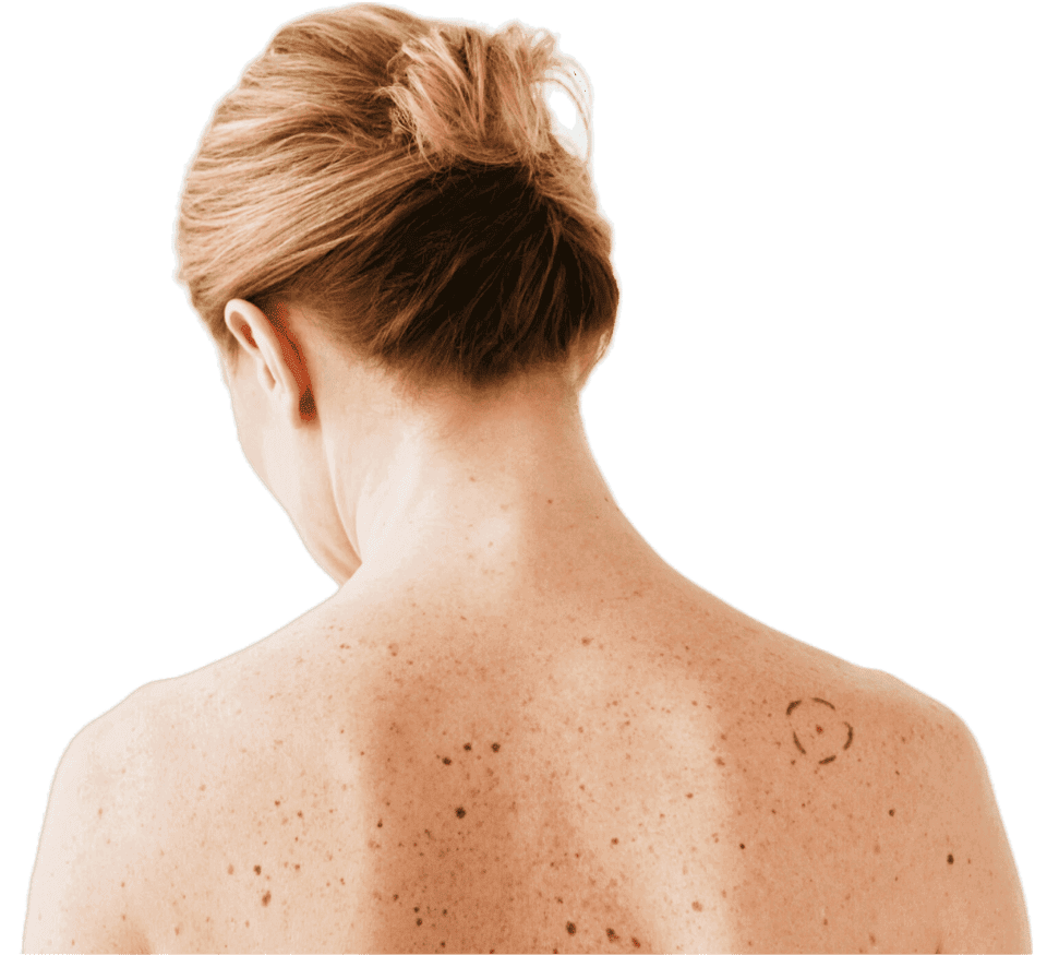 Skin Cancer Treatment London