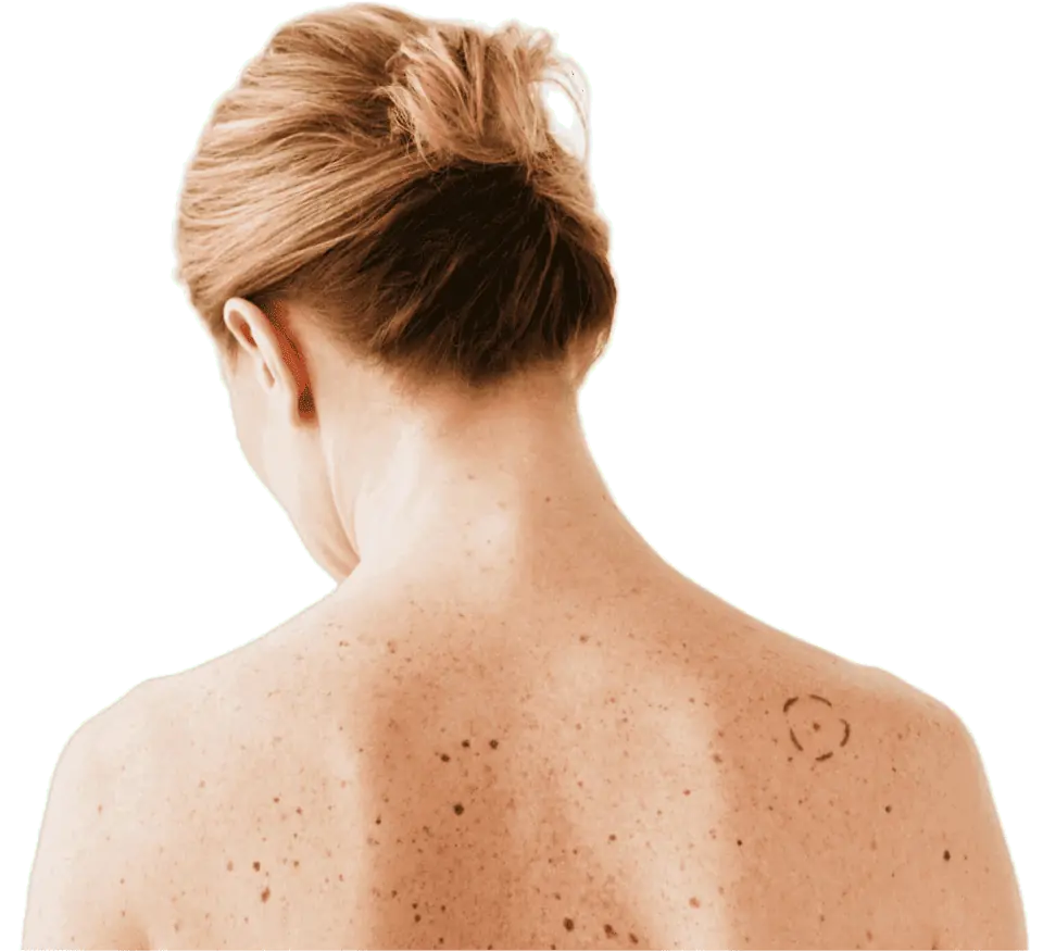 Skin Cancer Treatment London