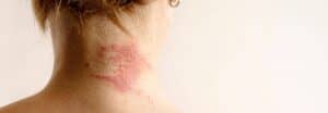 Eczema treatment