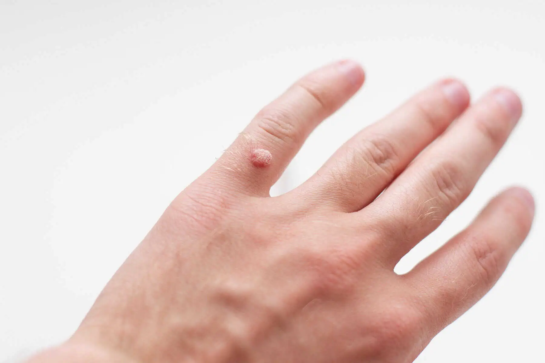 Wart Removal London