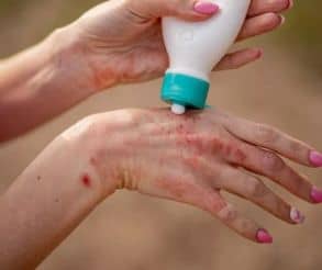 Symptoms of skin condition