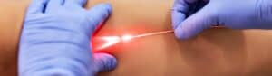 Endovenous Laser Ablation EVLA