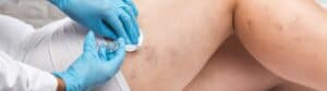 Sclerotherapy