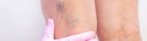 Varicose veins London