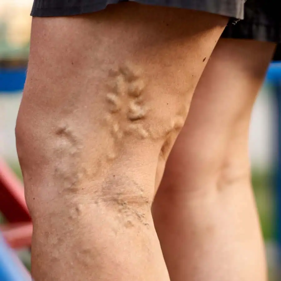 varicose vein treatment