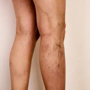 varicose vein treatments London