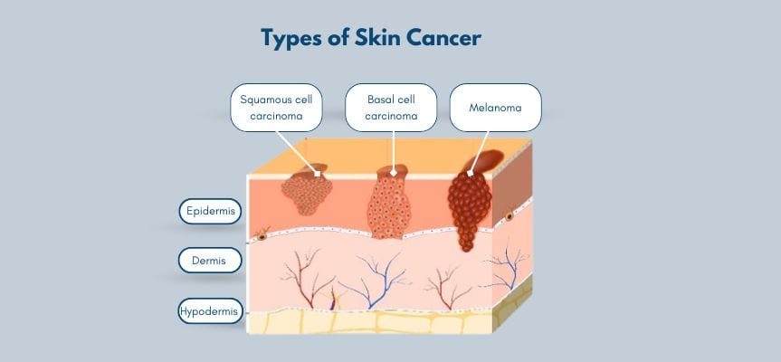 Melanoma Treatment Melanoma Treatment